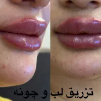 خدمات تخصصی  ژل و بوتاکس فیلر فول فیس