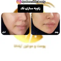 جشنواره تزریق ژل ۳۸۰ هزاروبوتاکس توسط کادردرمان|خدمات آرایشگری و زیبایی|اندیمشک, |دیوار