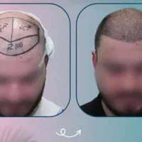 مدل کاشت موی  طبیعی