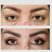 عمل رفع افتادگی پلک بلفارو و سوپر کانتورینگ غبغب