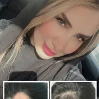 ریزش سکه ای(آلوپسی)