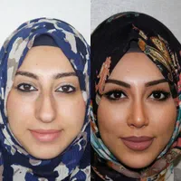 جراحی عمل بینی ۲۴ میلیونی/رینوپلاستی/بینی فانتزی