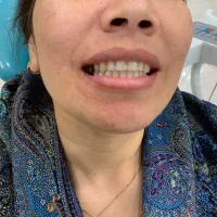 دندان مصنوعی (پروتز)|خدمات آرایشگری و زیبایی|گالیکش, |دیوار