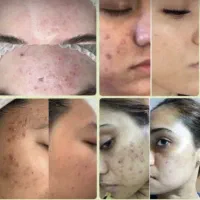 رفع کدری پوست|آرایشی، بهداشتی، درمانی|شیراز, ریشمک|دیوار