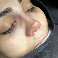 عمل جراحی بینی