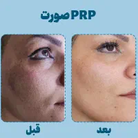 پی ار پی (prp)و مزوتراپی و بوتاکس پوست مو در منزل