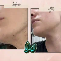 الکترولیز موسفید(لیزر نیست.رفع دائمی)کلینیک ایرانا