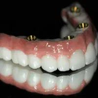 دندانپزشکی اوردنچر دوفک فقط ۱۰۰ تومن در تبریز