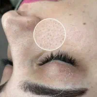 آف باورنکردنی فیشیال فوق پیشرفته اولین‌باردرایذه|خدمات آرایشگری و زیبایی|ایذه, |دیوار