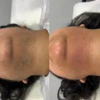 لیزر کل بدن (فول بادی)فقط۴۹۰تومن|خدمات آرایشگری و زیبایی|گنبد کاووس, |دیوار