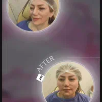 تزریق چربی ،فیلر بادی،عمل پلک،ژل و بوتاکس|خدمات آرایشگری و زیبایی|تهران, صادقیه|دیوار