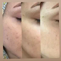 با جوش های صورتت خداحافظی کن