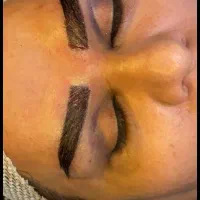 کاشت مو ابرو وشقیقه