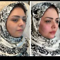 جشنواره  خدمات واموزش ژل وبوتاکس فقط بانوان