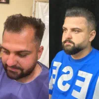 کاشت مو ده میلیون تومان در شیراز