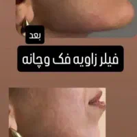 ژل لب گونه چونه زاویه مادلینگ راویه سازی|خدمات آرایشگری و زیبایی|قم, تولید دارو و یخچال|دیوار