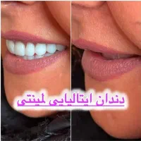 دندانسازی / دندان مصنوعی/ جوان پسند لمینتی/اقساط|خدمات آرایشگری و زیبایی|مشهد, عبادی|دیوار