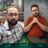 کاشت موی طبیعی/ اولین مرکز کاشت شقیقه ایران