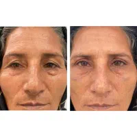 عمل افتادگی پلک ( بلفاروپلاستی ) با تعرفه دولتی|خدمات زیبایی و سلامت|تهران, سلسبیل جنوبی|دیوار