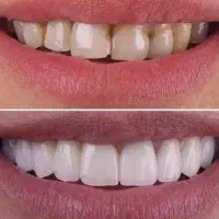 لمینیت دندان هر یک دندان ۶ میلیون تومان