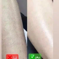 لیزر موهای زائد