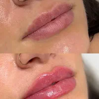 تزریق فیلر و بوتاکس