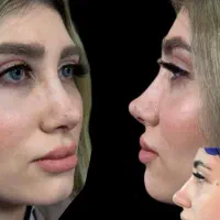 عمل بینی رینوپلاستی با ۴۰ تومن/پیکرتراشی/اسلیو