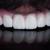 دندانپزشکی ایمپلنت کامپوزیت لمینیت روکش دندان|خدمات آرایشگری و زیبایی|تبریز, |دیوار