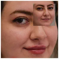 تزریق انواع بوتاکس ،ژل،مزوتراپی ،نخ.انزیم|خدمات آرایشگری و زیبایی|مشهد, سرافرازان|دیوار