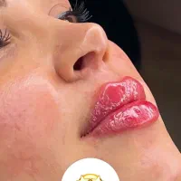 تزریق فیلر و بوتاکس و هایفو و لیزر اندولیفت