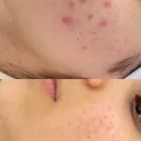 فیشیال تخصصی و درمانی پوست|خدمات آرایشگری و زیبایی|آمل, |دیوار