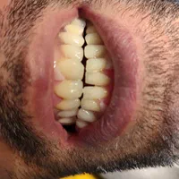 دندانسازی و دندان مصنوعی|خدمات آرایشگری و زیبایی|تبریز, |دیوار