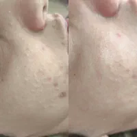 پاکسازی صورت|خدمات آرایشگری و زیبایی|زنجان, |دیوار