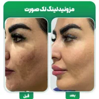 فیشال تخصصی درمان لک . جای جوش .