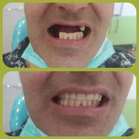 دندانسازی حور