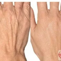 تزریق فیلرهای بدن(دست-مچ پا-باسن)ساکشن غبغپ|خدمات آرایشگری و زیبایی|اصفهان, ملک‌شهر|دیوار