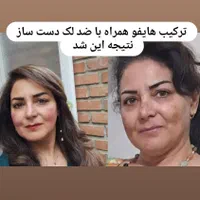لیزرموزائد سوپرانوتیتانیوم آلما