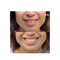 بوتاکس و ژل|خدمات آرایشگری و زیبایی|تهران, مطهری|دیوار