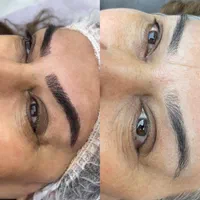 میکروبلیدینگ فیبروز شیدینگ لب خط چشم ریموو