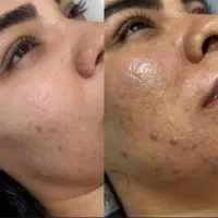 مدل جهت فیشال در مطب زیبایی(بانوان،آقایان)