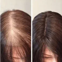 قطع ریزش مو و رشد مجدد