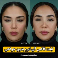 آف پکیج تخصصی FOX EYE پزشک پوست مو بینی زیبایی|خدمات آرایشگری و زیبایی|مشهد, هنرستان|دیوار