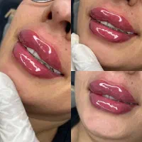 فیلر لب ژل لب بوتاکس پی آر پی ریمو تتو فول فیس