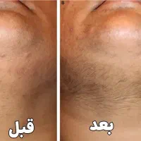 جدیدترین دستگاه لیزر 2025 در شهر جم|خدمات آرایشگری و زیبایی|جم, |دیوار