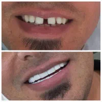 کامپوزیت زیبایی دندان درکلینیک دندانپزشکی|خدمات آرایشگری و زیبایی|یاسوج, |دیوار