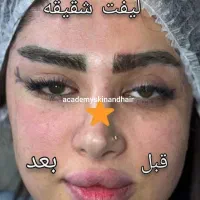 بمب تخفیف ژل ،بوتاکس،نخ وغیره فقط دوهفته لارم