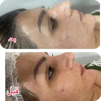 فیشال و نخ کلاژن به جای بوتاکس|خدمات آرایشگری و زیبایی|اصفهان, کوی ولی عصر|دیوار