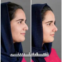 لیفت جراحی بینی بلفارو ژل لب بوتاکس مزو فشیال|خدمات آرایشگری و زیبایی|شاهین‌شهر, طالقانی|دیوار