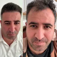 کاشت موی دوروزه فقط ۱۹ میلیون