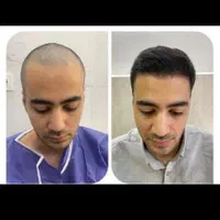 کاشت مو و ابرو در میانه|خدمات آرایشگری و زیبایی|میانه, |دیوار